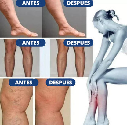 PARCHES PARA VARICES